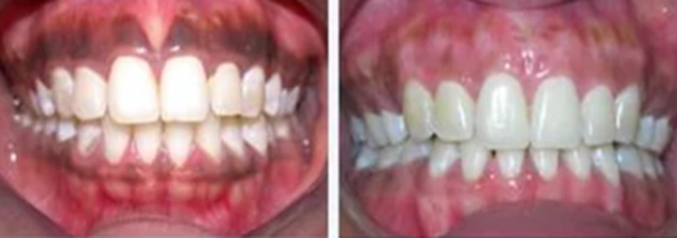 Unveiling The Beauty: A Comprehensive Guide To Gingival Depigmentation